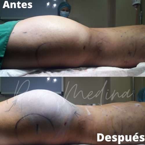 MINI LIPO + TRANSFERENCIA