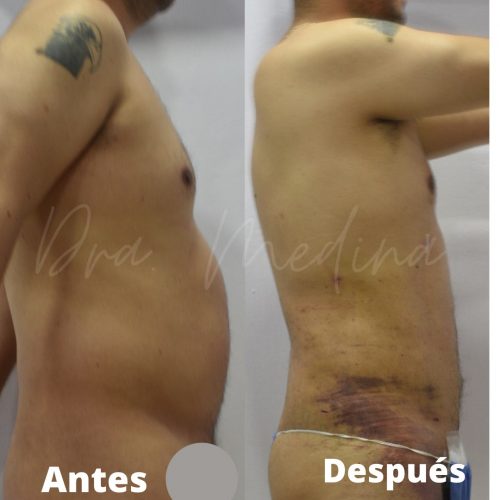 LIPO DE ABDOMEN