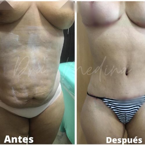 Lipoescultura + abdominoplastia y reducción mamaria con prótesis