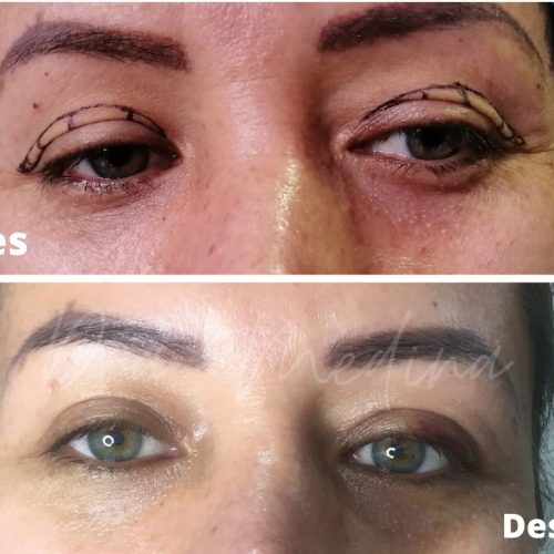 BLEFAROPLASTIA PARPADO SUPERIOR