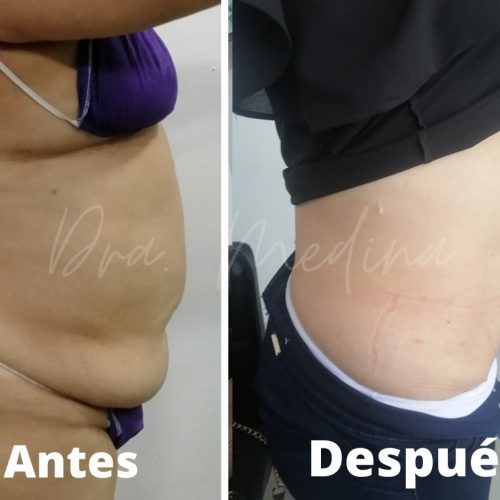 Lipo de abdomen + dermolipectomia