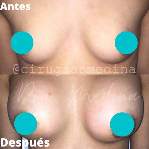 MAMOPLASTIA DE AUMENTO CON PROTESIS