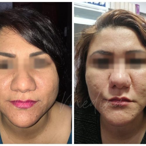 BICHECTOMIA + RINOPLASTIA ESTETICA