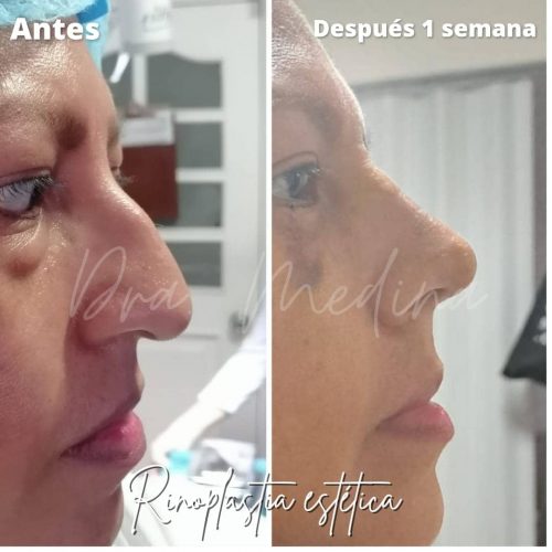 Cirugías Medina Rinoplastia