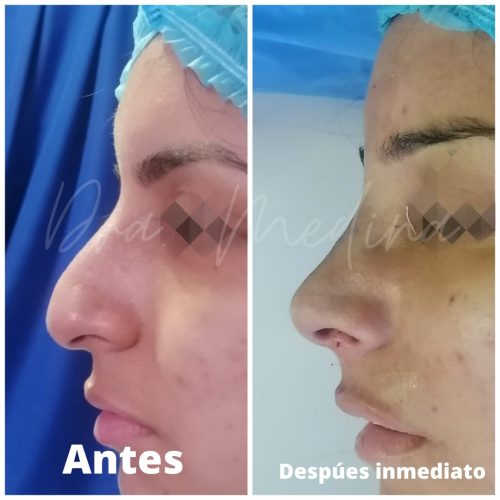 Rinoplastia estética