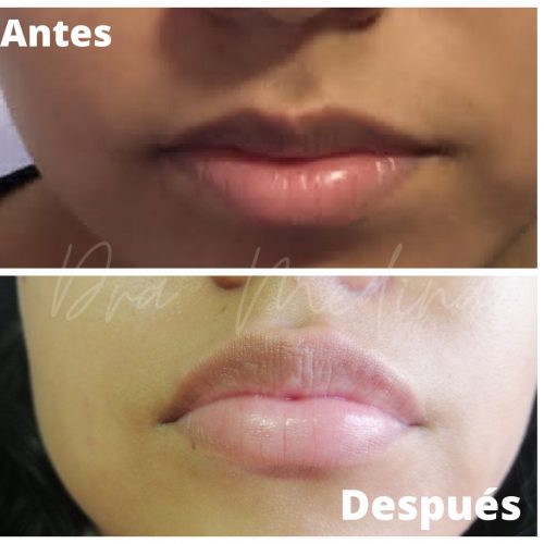 RELLENO DE LABIOS CON ACIDO HIALURONICO