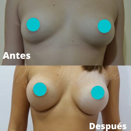 MAMOPLASTIA DE AUMENTO