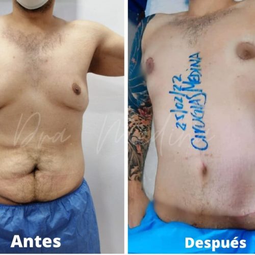 ABDOMINOPLASTIA + GINECOMASTIA