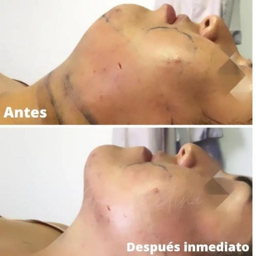 LIPOPAPADA