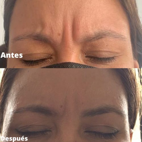 BOTOX EN FRENTE Y ENTRECEJO