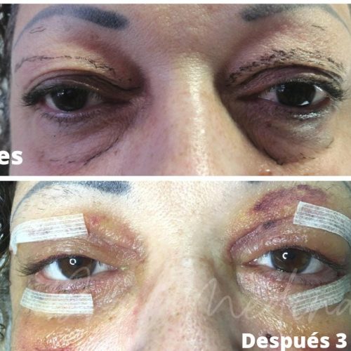 BLEFAROPLASTIA SUPERIOR E INFERIOR