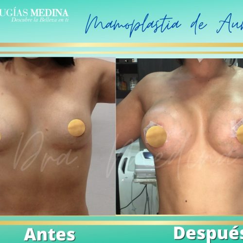 MAMOPLASTIA DE AUMENTO