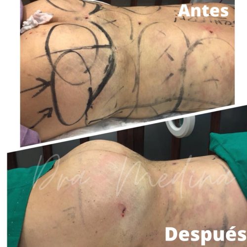 LIPOESCULTURA + TRANSFERENCIA