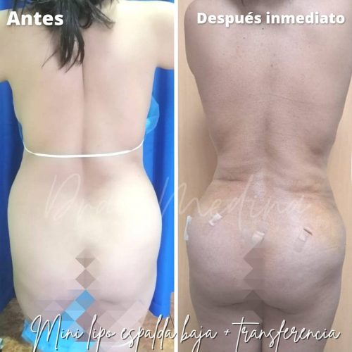 Cirugías Medina mini lipo de espalda baja + transferencia